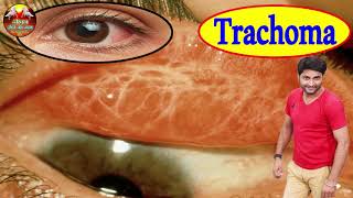 ट्रेकोमा रोग क्या है और यह कैसे होता है || what is trachoma eye disease || trachoma eye disease