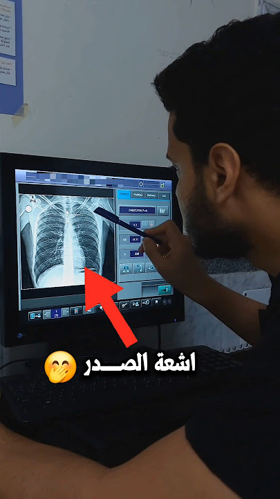 اي اللي بيظهر في اشعة الصدر🤭#shorts