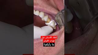 إنقاذ الاسنان قبل فوات الاوات