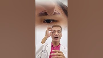 Lựa chọn chỉ định nâng cung mày cũng rất quan trọng |Dr Hùng Thanh