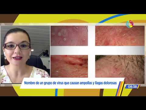 Vídeo: Herpes: Síntomas, Tratamiento, Tipos, Fotos