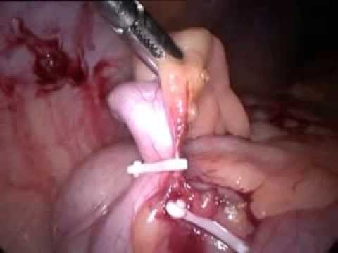 Lap. Appendectomy (unedited-25)-Recurrent Appendicitis, Simple Inflamed, Hemolock Clips Used