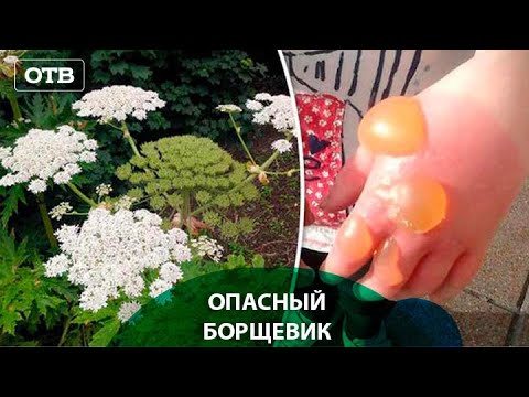 Ребенок получил сильный ожог от смертельно опасного борщевика | #ОТВ