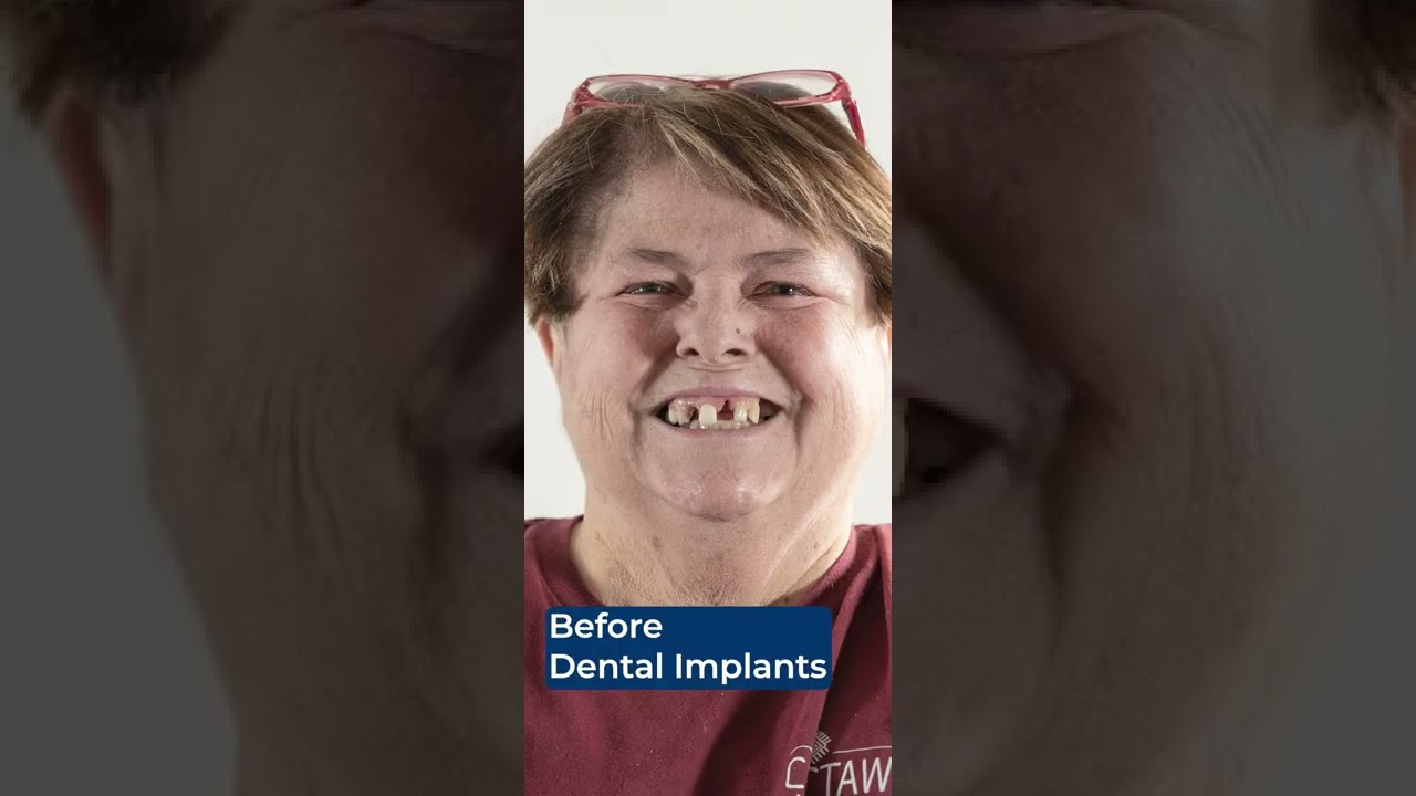 Before and After Nuvia's Permanent Teeth in 24-Hours! 🎉