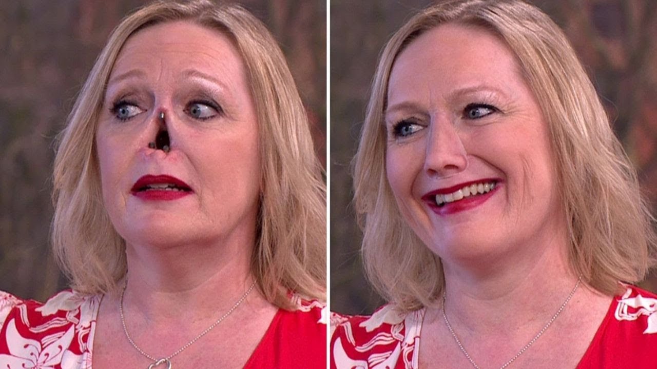 Ринофима Носа Фото — Картинки фотографии