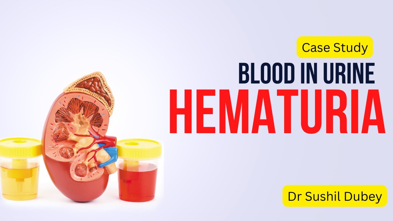 Blood In Urine, Kidney Stone, Homeopathy Medicine and Treatment