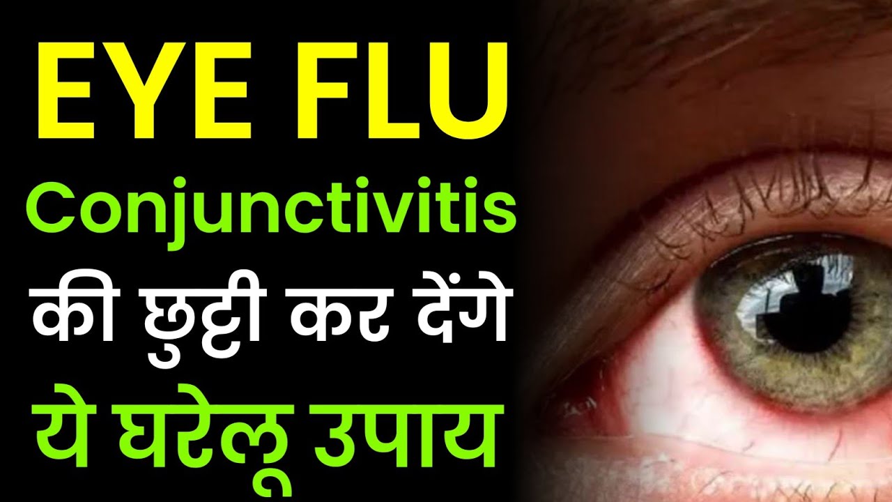 आई फ्लू ठीक कैसे करें Eye Flu Thik Kaise Kare आई फ्लू का इलाज और