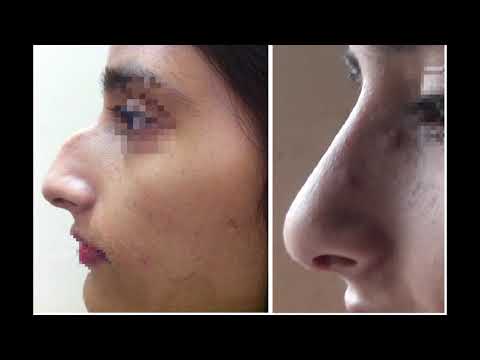 hump reduction rhinoplasty: Rhinoplasty Pakistan thumbnail image