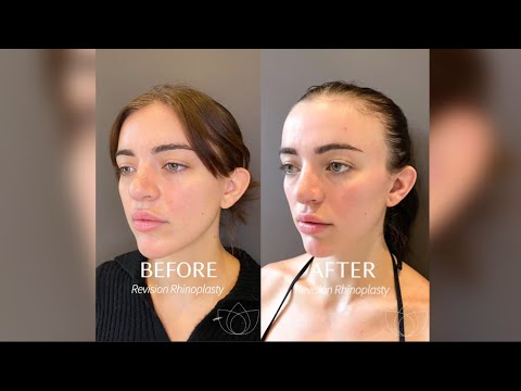 Video thumbnail: Revision Rhinoplasty @AlbertPlasticSurgery · Albert Plastic Surgery New York