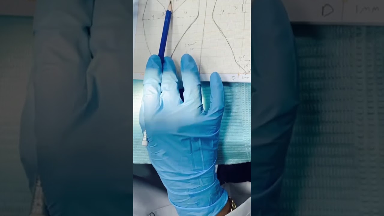 نحت الناب العلوي Carving of Maxillary right canine 