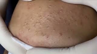 Blackheads Whiteheads Removal New 2024 Acne Treatment With Nhat Bang