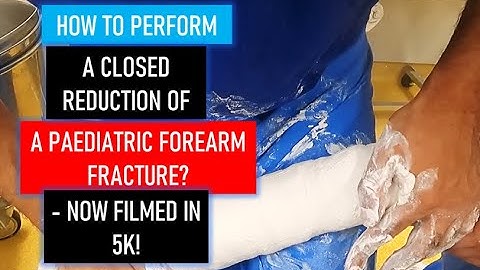 TRAUMA: How to perform a Closed Reduction of a Paediatric Forearm Fracture
