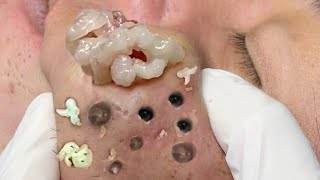 Relax Every Day With Treatment Satisfying blackhead relaxing acne, pimple, cyst by FISHING VIDEO 502 views 1 year ago 5 minutes, 15 seconds