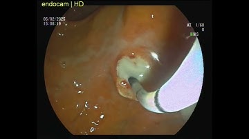 👩‍⚕️🏥Acute cholecystitis and acute cholangitis 🦠🌡️Ampulla not visible due to PUS