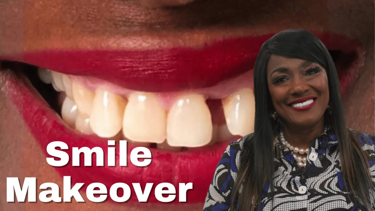 Hollywood Smile Transformation Is EVERYTHING She Dreamed It Would Be