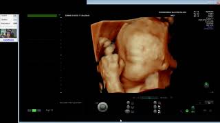 FETAL BEHAVIOUR NORMAL 29 WEEKS (Dr Wiku Andonotopo)