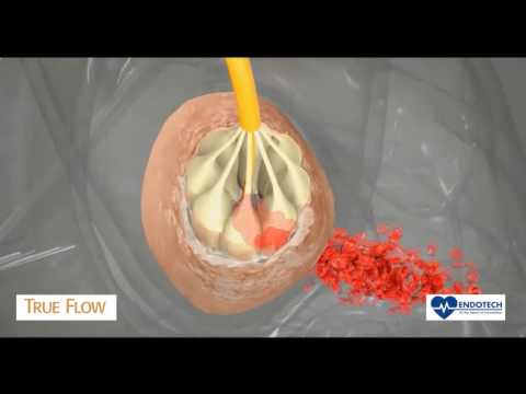TRUEFLOW - Catetere a perfusione per Valvuloplastica Aortica