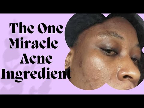 How I Got Rid of my Acne With Only 1 Ingredient *Its Magic* - YouTube