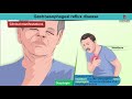 Gastroesophageal reflux disease Animation / GERD : Etiology , Diagnosis , Pathology , Treatment