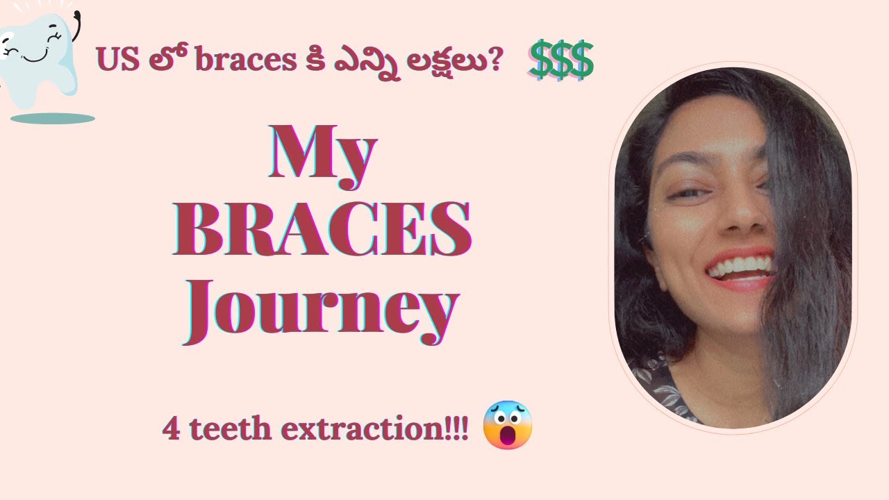 My BRACES Journey 🤯 Cost of braces, Teeth extractions, Types etc