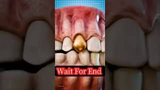 Why Dentists Still Use Gold Teeth 🤔