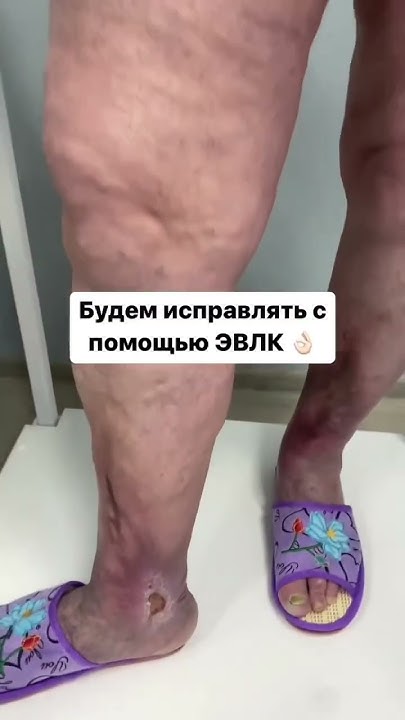 Язвы на двух ногах #shorts #тренды #рекомендации #советы #врач #варикоз ...
