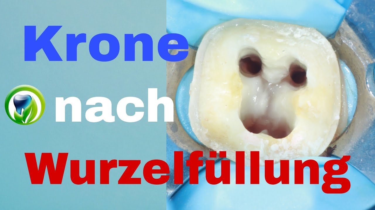 Muss ein wurzelbehandelter Zahn überkront werden? eine Krone bekommen? Krone nach Muss ein wurzelbehandelter Zahn überkront werden? eine Krone bekommen? Krone nach