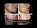 Watch Extreme Acne Treatment, Laser And Pus Fly Widely - Laser Acne Treatment