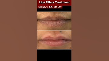 At Last, The Secret To LIPS FILLERS TREATMENT Is Revealed | Viral #shorts