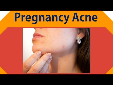 Pregnancy Acne  | Apple Cider Vinegar, Baking Soda Remedy