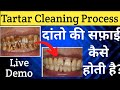 Teeth Cleaning Process At Dentist  |Danto Ki Safai |Tartar Removal On Patient |दांतो की सफाई हिंदी