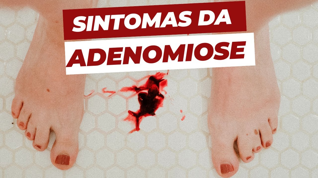 Adenomiose: conheça os sintomas