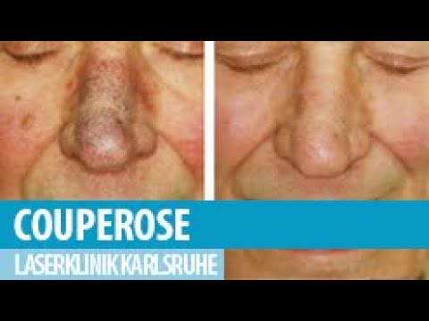 Video: Couperose - Behandlung, Entfernung Im Gesicht, Ursachen, Rosacea Bei Kindern