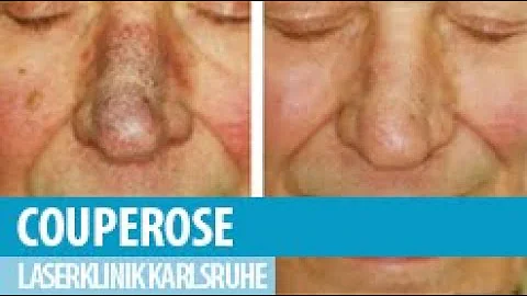 Come alleviare il rossore della rosacea?