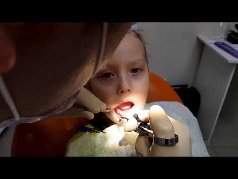Удаление зубов у детей