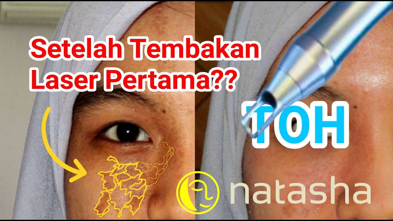 Kondisi Flek Pasca Laser Natasha Skincare Sidoarjo Youtube