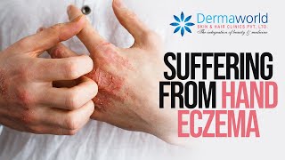 Suffering from hand eczema? #shots