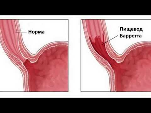 Что нужно знать о раке пищевода? (подкаст)