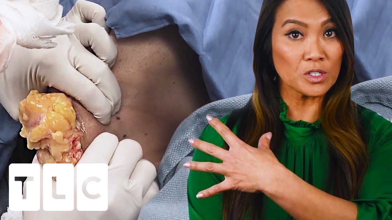 It's Going To Be Satisfying": The Pops | Dr. Pimple Popper: This is Zit - YouTube