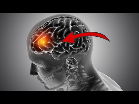 Vídeo: Trobareu els primers símptomes d'un tumor cerebral als ulls