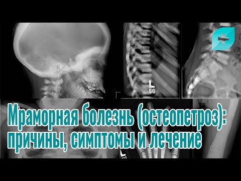 Мраморная болезнь (остеопетроз): причины, симптомы и лечение