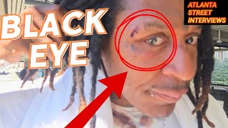 44, POLO, NOW HAS A BLACK EYE AND BLOODY SHIRT!