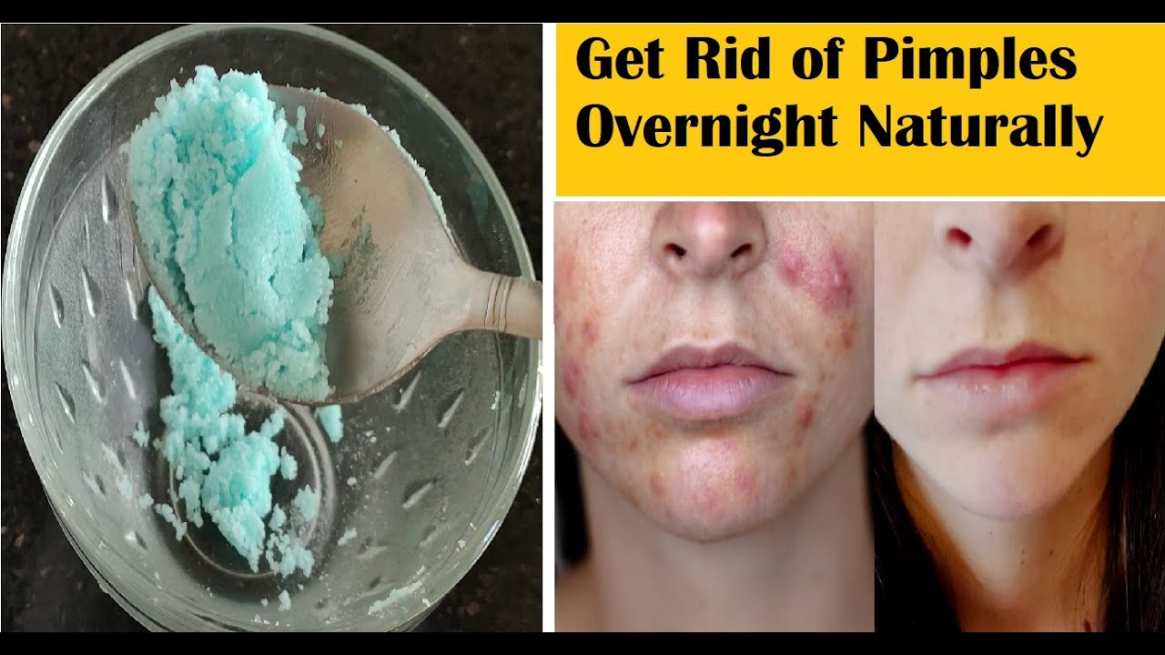 Shocking ! How to Get Rid of Pimples Overnight || Get Rid of Acne ...
