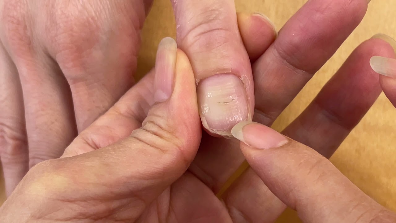 ネイルベッド ピンク部分 が伸びすぎた親指がある右手の爪の状態と施術方針の解説 1 7 Youtube