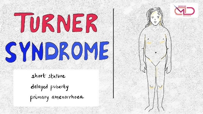 turner syndrome facts