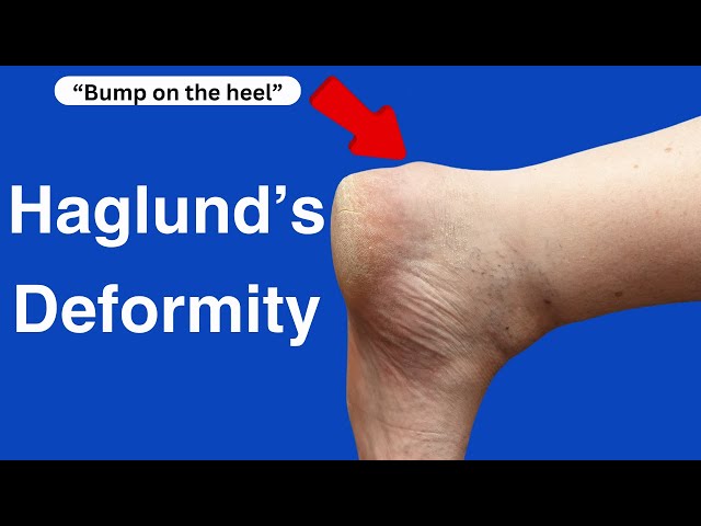  Haglund's Deformity