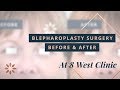 Blepharoplasty Transformations (Upper Eyelid Lift Surgery) with Dr. Thomas Buonassisi in Vancouver