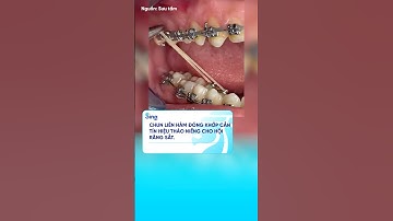 Biểu hiện của sắp tháo niềng cho hội răng sắt #nhakhoasing #trending #shots #virals #niengrang