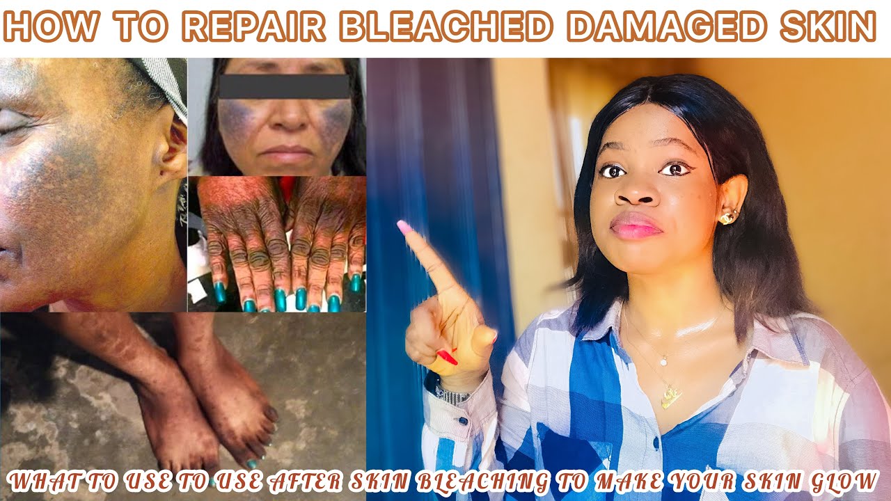 HOW TO REPAIR BLEACHED SKIN: What To Use After Skin Bleaching To Make ...