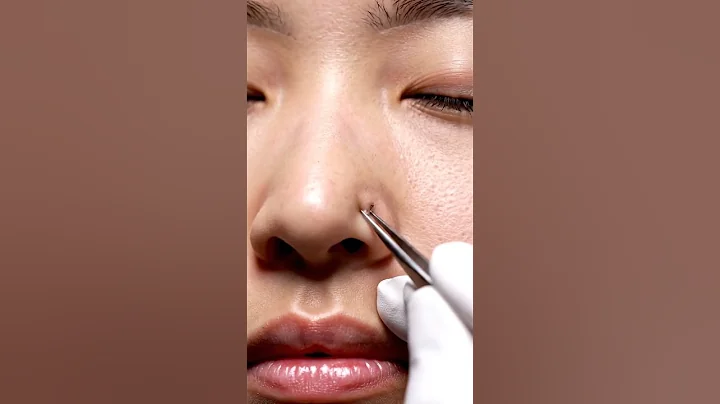 Most Satisfying Blackhead Pops Ever | Relaxing ASMR Video